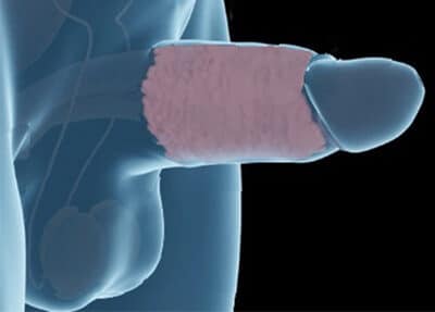 penile-girth-enlargment Penile Girth Enlargement Tampa Bay