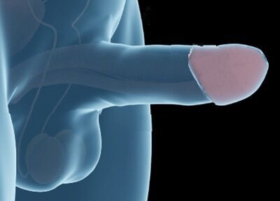 penile-glans-enlargment Penile Glans Enlargement Tampa